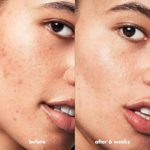 e.l.f. SKIN Blemish Breakthrough Akne Nazorat Asoslari To'plami, Sayohat O'lchamdagi Akne Teri Parvarishi Rutinasi, Tozalovchi, Serum & Namlovchi, Vegan & Hayvonlar Ustida Sinovdan O'tkazilmagan - 4