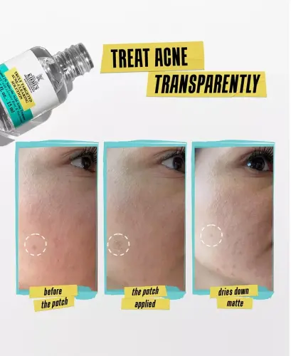 Truly Targeted Acne-Clearing Solution - No Color - 5