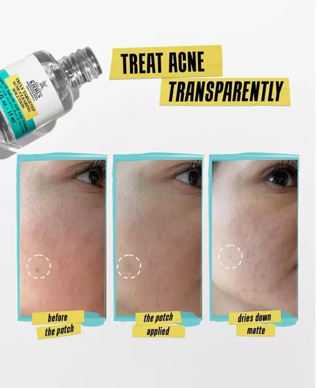 Truly Targeted Acne-Clearing Solution - No Color - 5