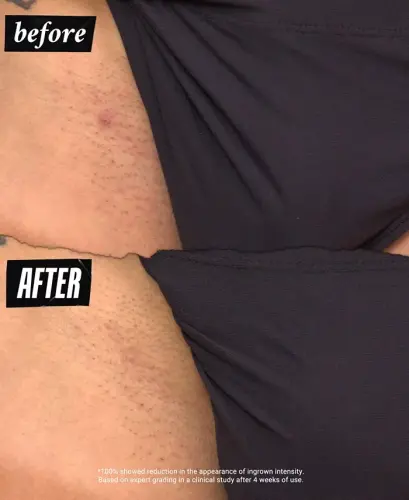 Ingrown Hair & Tone-Correcting Intimate Drops-Personals Ingrown Hair & Tone-correcting Intimate Drops - 8