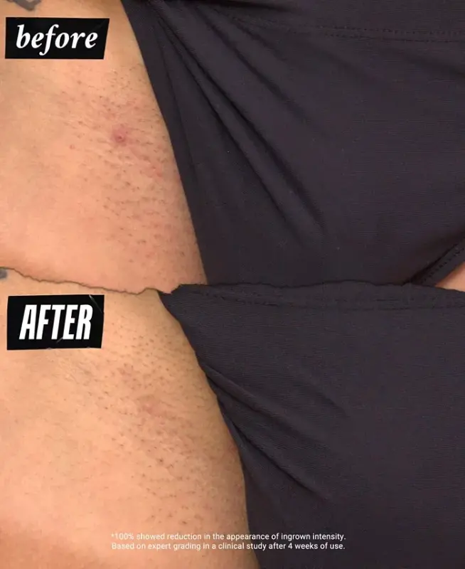 Ingrown Hair & Tone-Correcting Intimate Drops-Personals Ingrown Hair & Tone-correcting Intimate Drops - 8