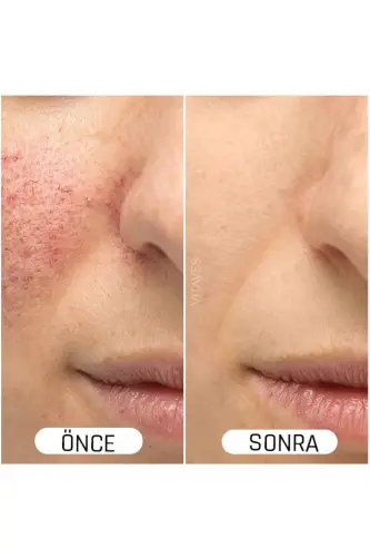 Skin Tone Evener Anti-Spot C Vitamin 10% Hyaluronic Acid Brightening Moisturizing Skin Serum - VITAYES (1)