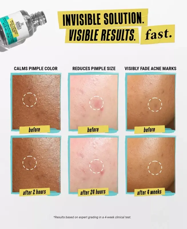 Truly Targeted Acne-Clearing Solution - 8